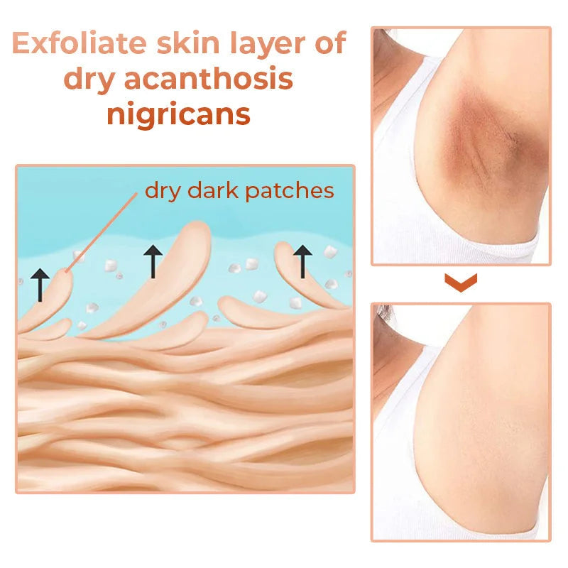 GFOUK™ Akanthose-Nigricans-Therapieöl