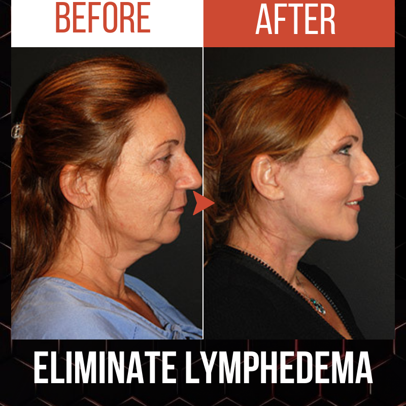 Appareil de drainage lymphatique pour le cou