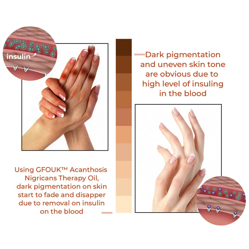 GFOUK™ Akanthose-Nigricans-Therapieöl