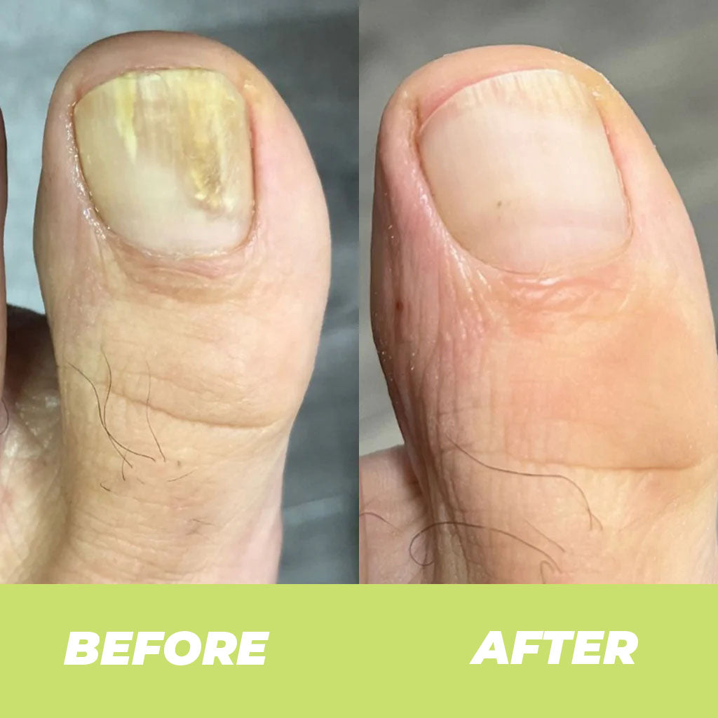 Gel Réparateur pour les Ongles