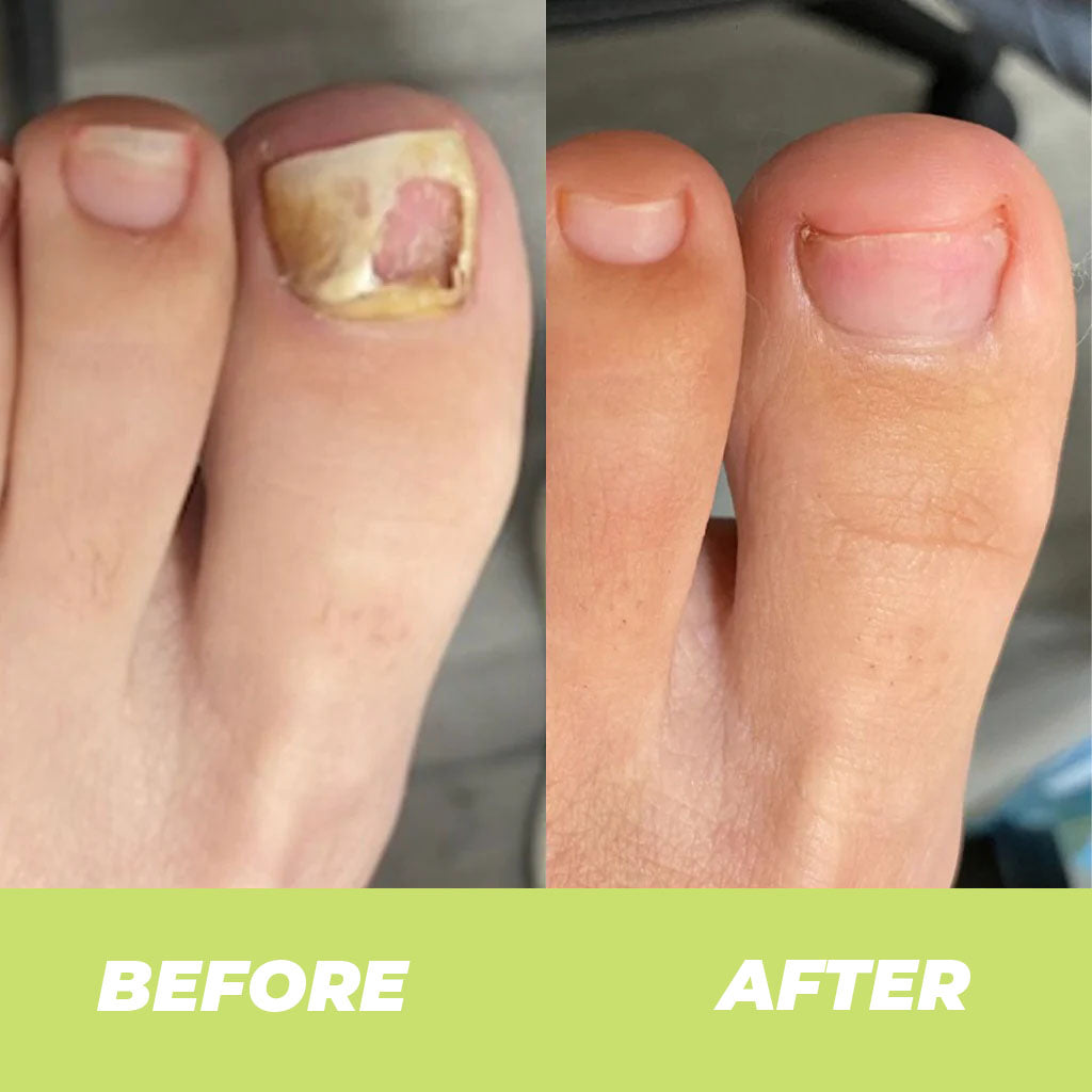 Gel Réparateur pour les Ongles